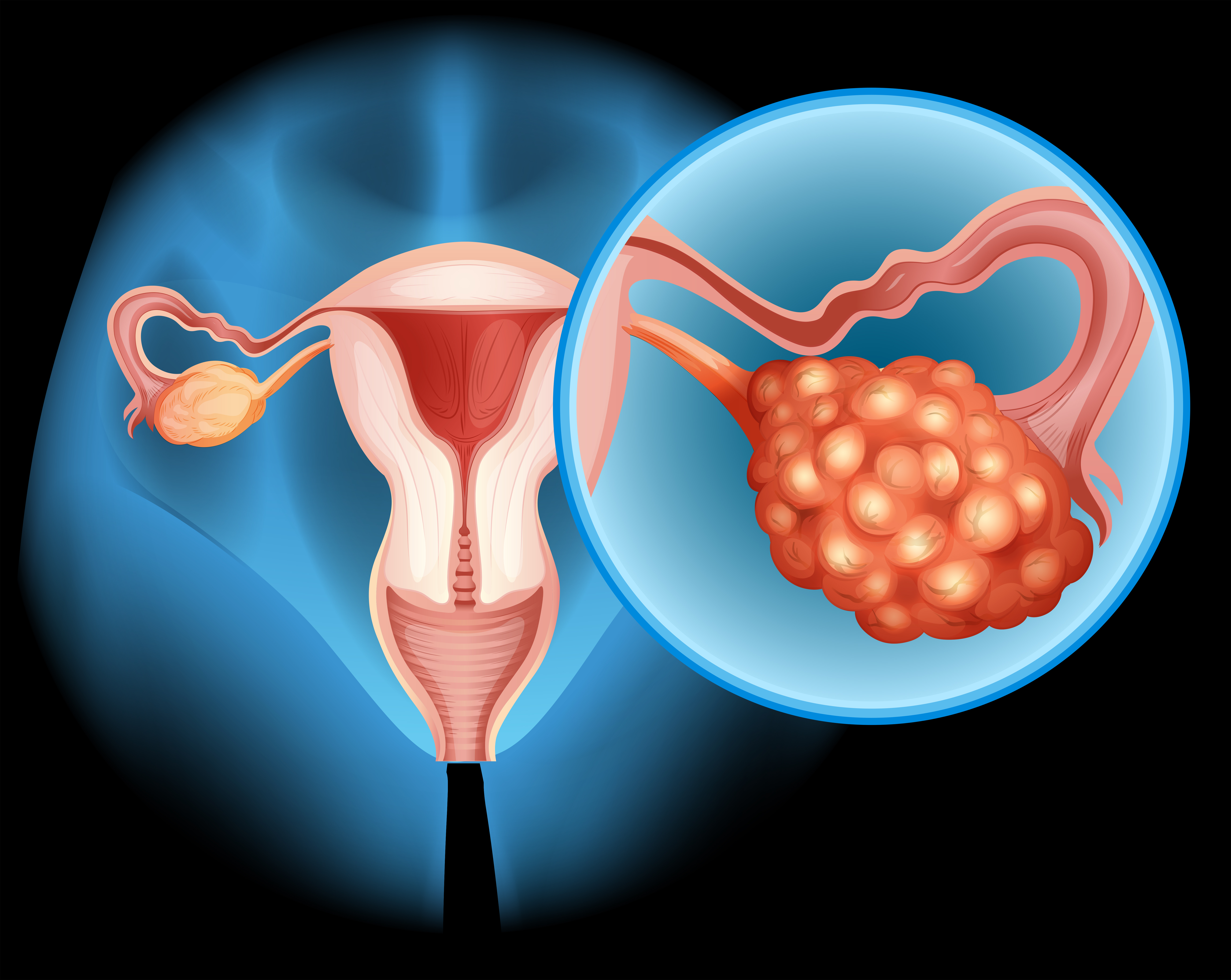 hpv ovarian diagram