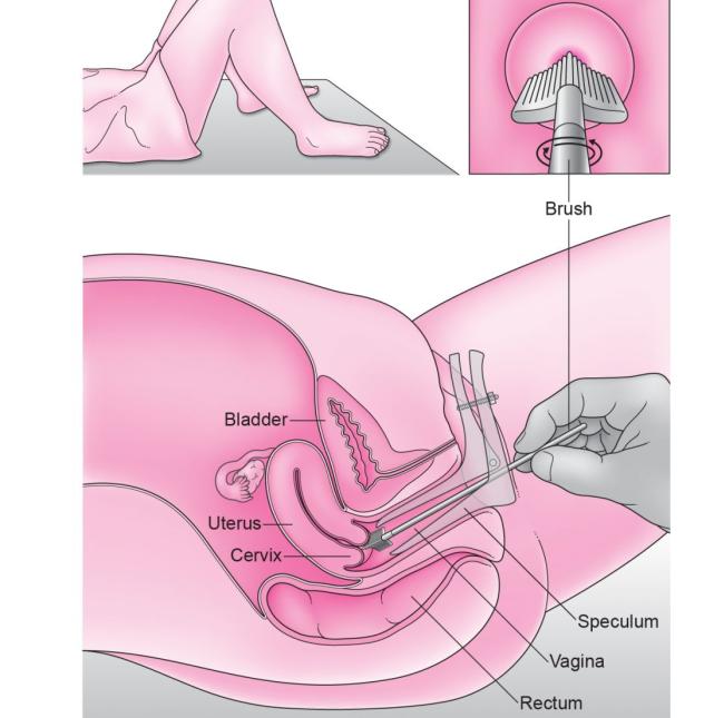 hpv test