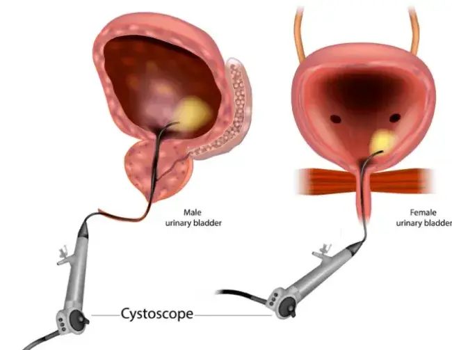 Cystoscopy