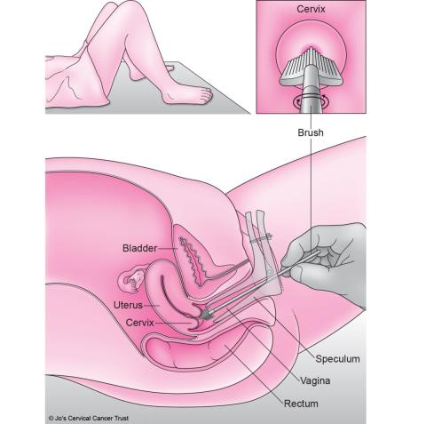 hpv test