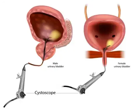 Cystoscopy