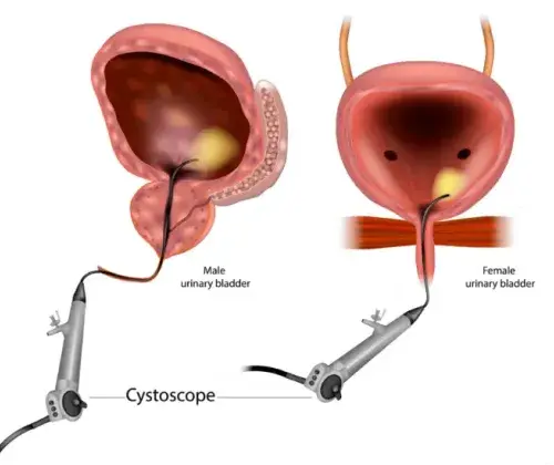 Cystoscopy